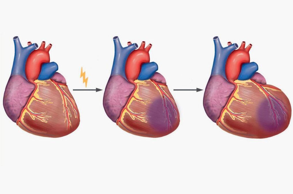 Սրտամկանի ինֆարկտը հանգեցնում է ուսի շեղբերների ցավի
