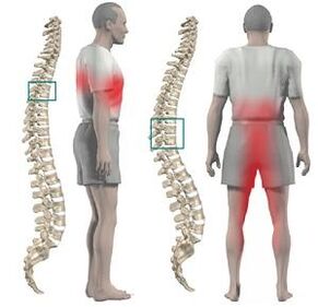 Thinacic Chondrosis- ի ցավը կարող է տրվել ստորին վերջույթներին եւ ճարմանդին