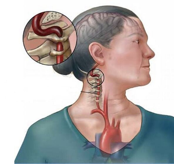 ողնաշարային զարկերակի համախտանիշ արգանդի վզիկի օստեոխոնդրոզով