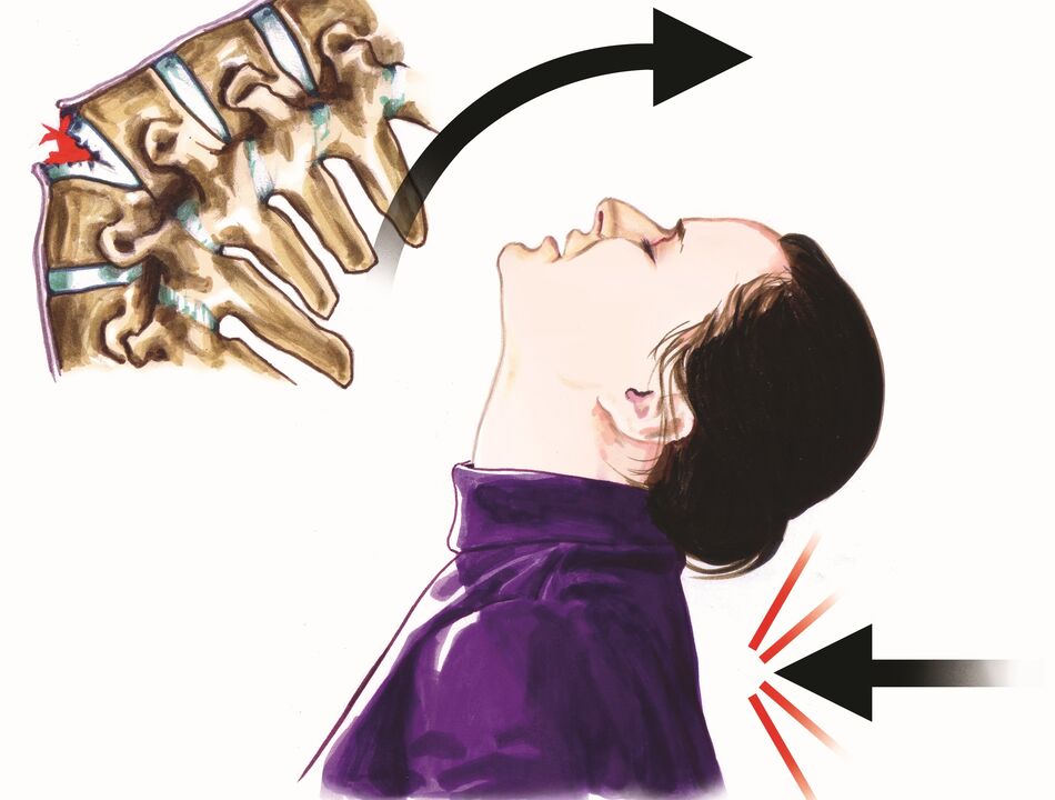 ողնաշարի վնասը՝ որպես պարանոցի ցավի պատճառ